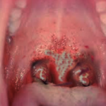 Africa’s Renewed Commitment to Ending Diphtheria: A Turning Point for Immunization and Health Security