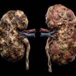 Ghana’s Kidney Crisis: How to Save Lives Now