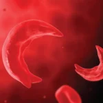 Sickle Cell Crisis: Corporate Ghana Must Act Now